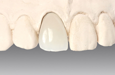 差し歯の種類 明野デンタルクリニック